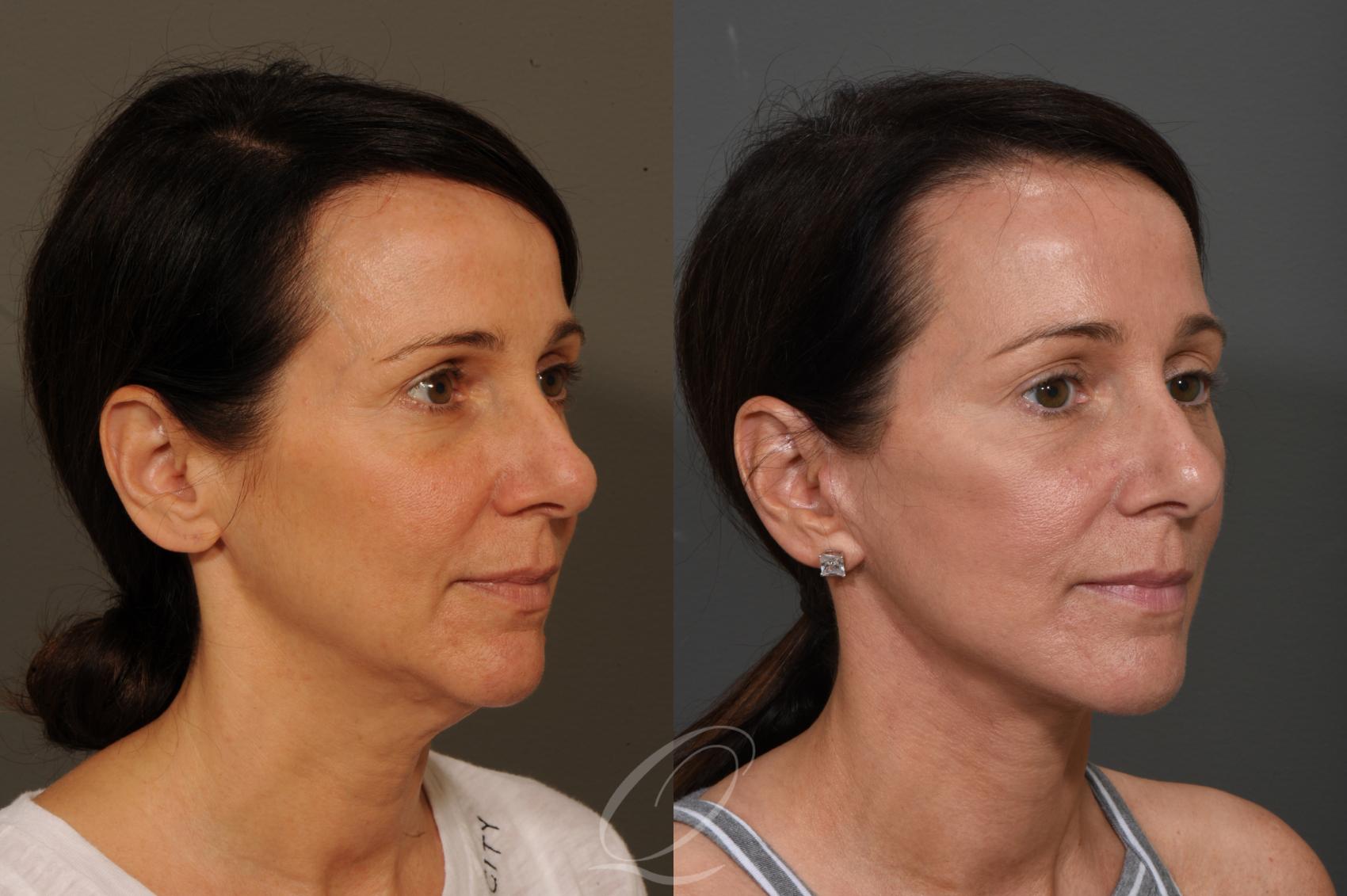 Facelift Case 349 Before & After View #2 | Serving Rochester, Syracuse & Buffalo, NY | Quatela Center for Plastic Surgery