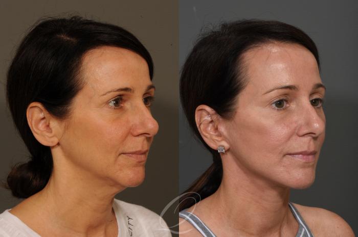 Fat Injections Case 349 Before & After View #2 | Serving Rochester, Syracuse & Buffalo, NY | Quatela Center for Plastic Surgery