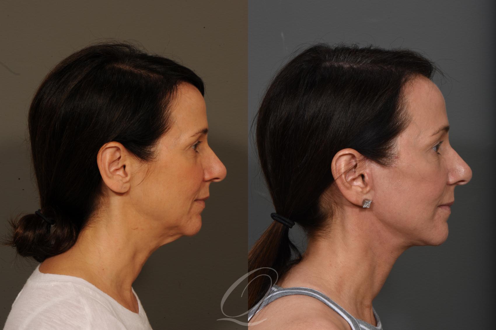 Facelift Case 349 Before & After View #3 | Serving Rochester, Syracuse & Buffalo, NY | Quatela Center for Plastic Surgery