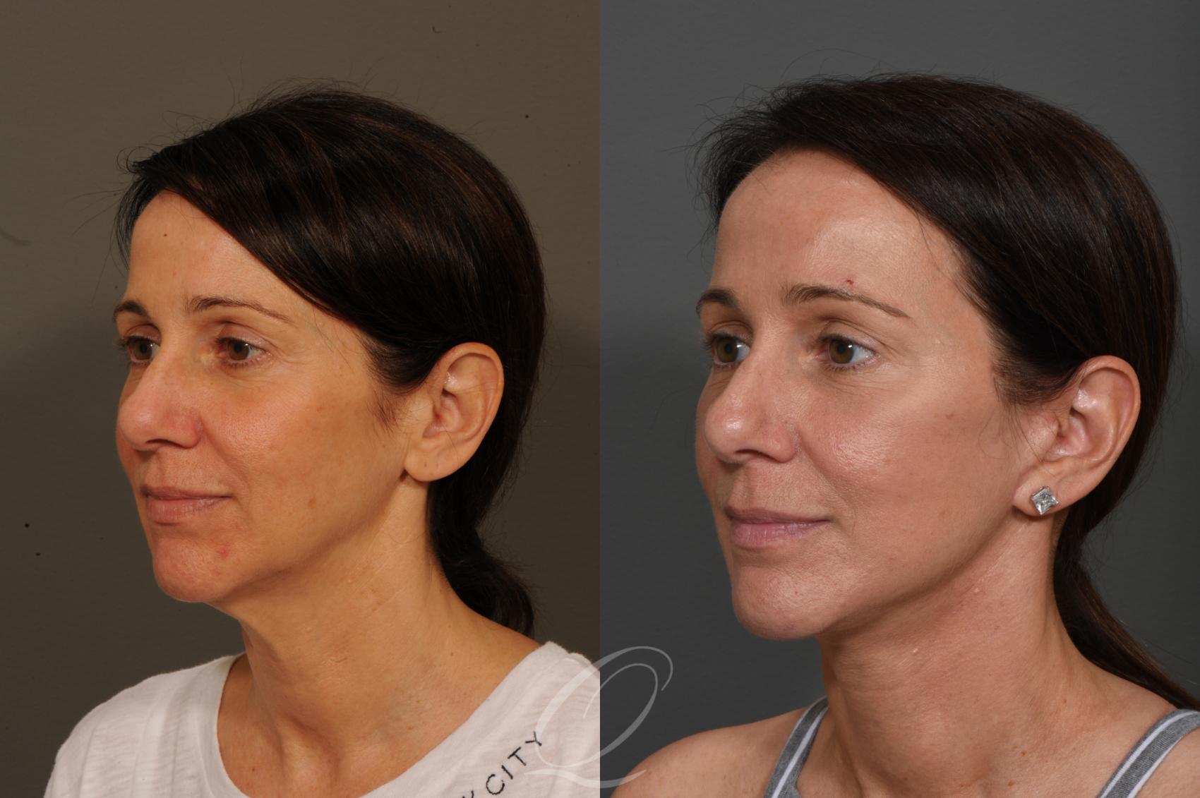 Facelift Case 349 Before & After View #4 | Serving Rochester, Syracuse & Buffalo, NY | Quatela Center for Plastic Surgery