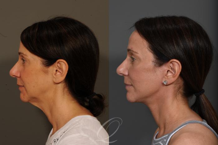 Fat Injections Case 349 Before & After View #5 | Serving Rochester, Syracuse & Buffalo, NY | Quatela Center for Plastic Surgery