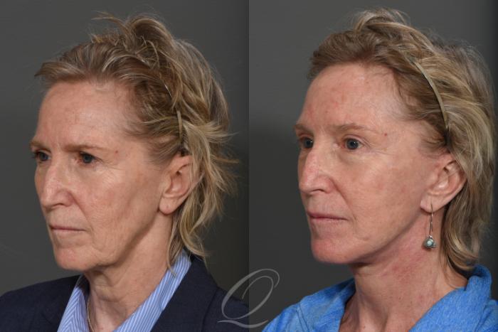 Facelift Case 352 Before & After View #2 | Serving Rochester, Syracuse & Buffalo, NY | Quatela Center for Plastic Surgery