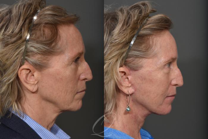 Facelift Case 352 Before & After View #3 | Serving Rochester, Syracuse & Buffalo, NY | Quatela Center for Plastic Surgery