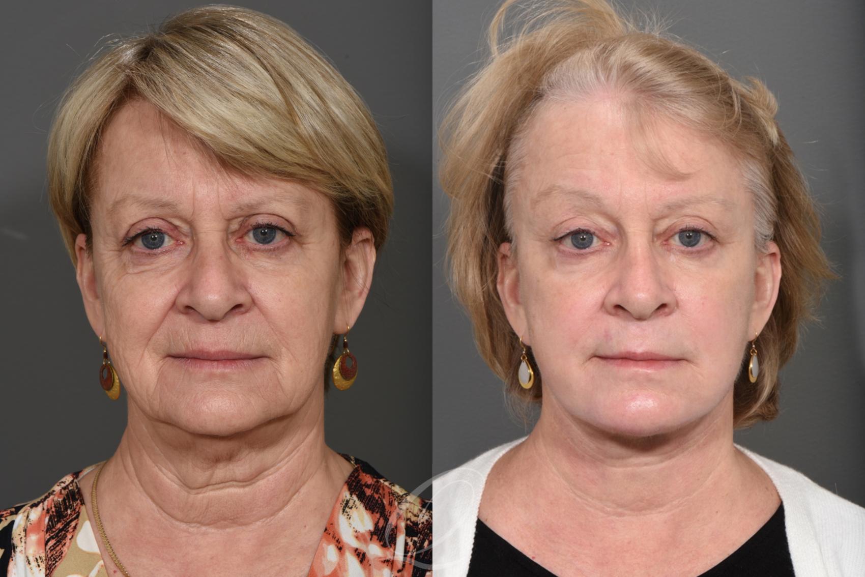 Facelift Case 353 Before & After View #1 | Serving Rochester, Syracuse & Buffalo, NY | Quatela Center for Plastic Surgery