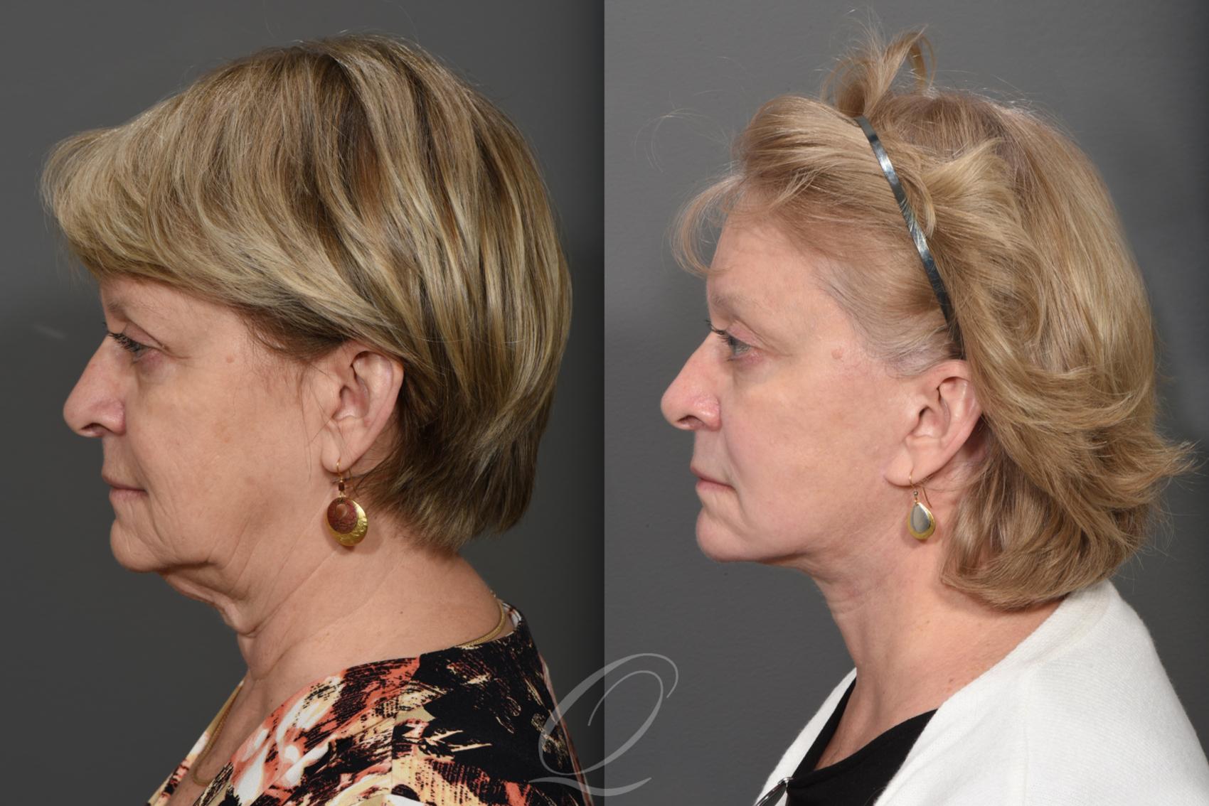 Brow Lift Case 353 Before & After View #2 | Serving Rochester, Syracuse & Buffalo, NY | Quatela Center for Plastic Surgery