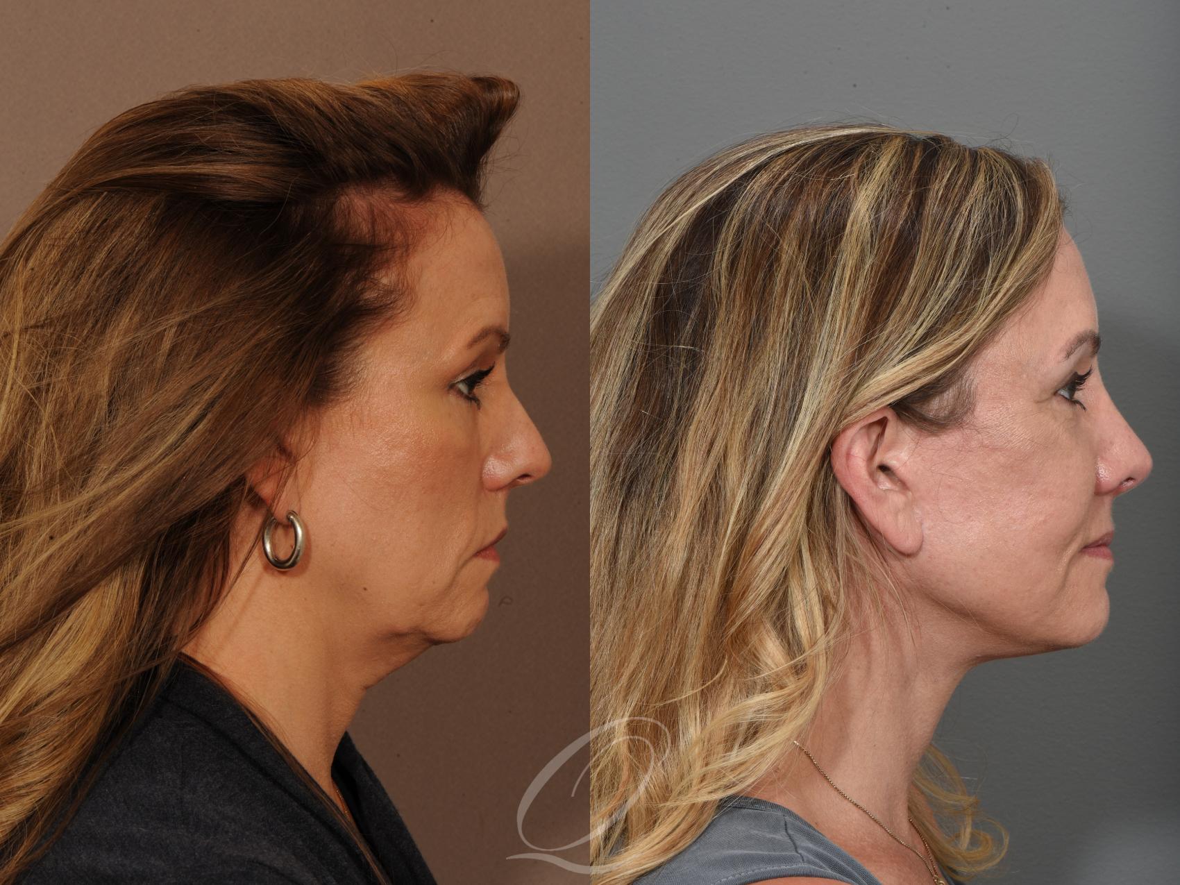 Facelift Case 357 Before & After View #1 | Serving Rochester, Syracuse & Buffalo, NY | Quatela Center for Plastic Surgery