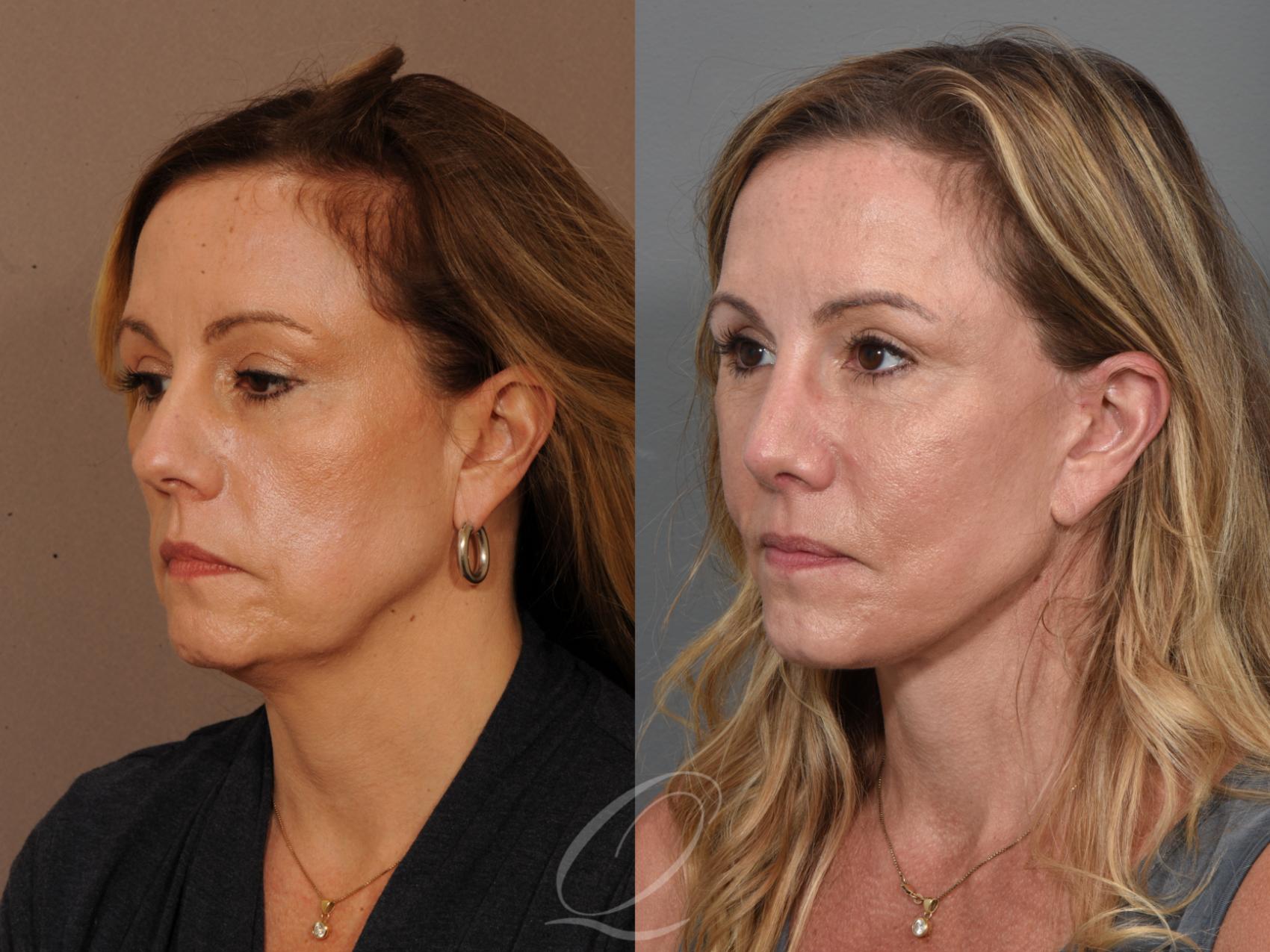 Fat Injections Case 357 Before & After View #2 | Serving Rochester, Syracuse & Buffalo, NY | Quatela Center for Plastic Surgery