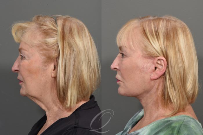 Facelift Case 408 Before & After Left Side | Serving Rochester, Syracuse & Buffalo, NY | Quatela Center for Plastic Surgery