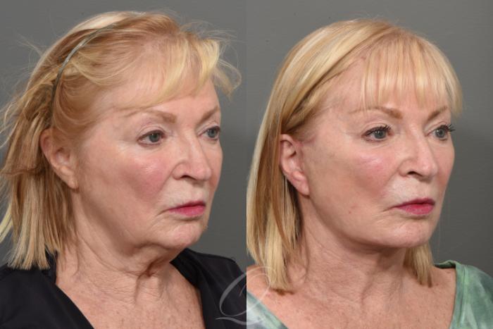 Brow Lift Case 408 Before & After Right Oblique | Serving Rochester, Syracuse & Buffalo, NY | Quatela Center for Plastic Surgery