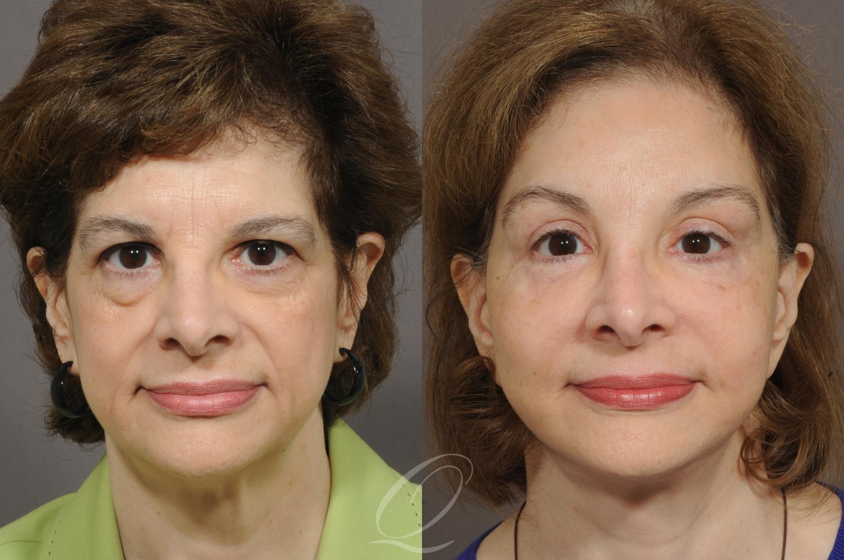 Fat Injections Case 214 Before & After View #1 | Serving Rochester, Syracuse & Buffalo, NY | Quatela Center for Plastic Surgery