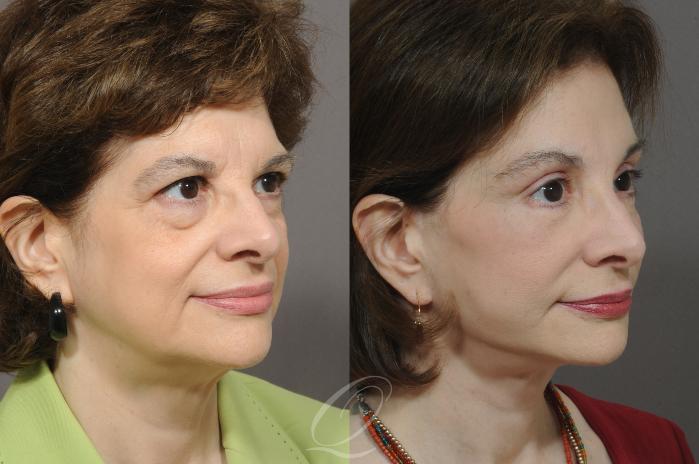 Fat Injections Case 214 Before & After View #2 | Serving Rochester, Syracuse & Buffalo, NY | Quatela Center for Plastic Surgery