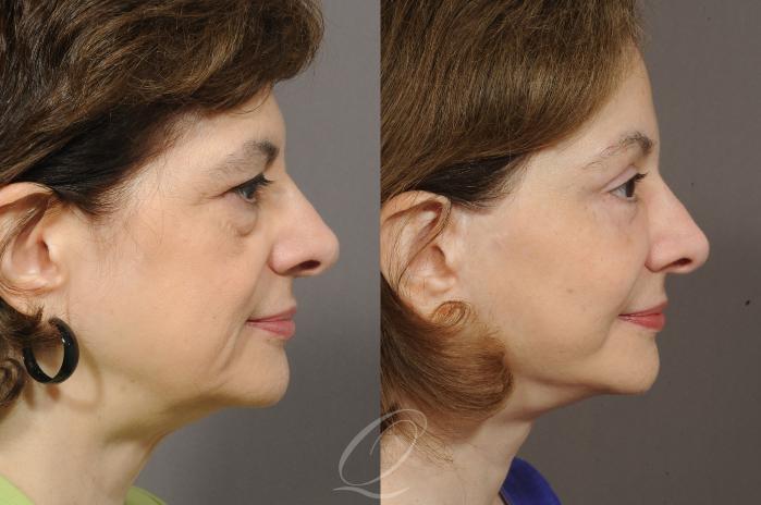Fat Injections Case 214 Before & After View #3 | Serving Rochester, Syracuse & Buffalo, NY | Quatela Center for Plastic Surgery