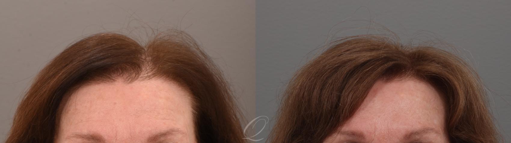 Before & After Female FUT Hair Transplant Case 1001889 Front View in Rochester, Buffalo, & Syracuse, NY