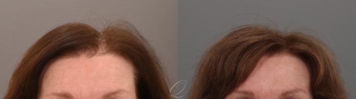 Before & After Female FUT Hair Transplant Case 1001889 Front View in Rochester, Buffalo, & Syracuse, NY