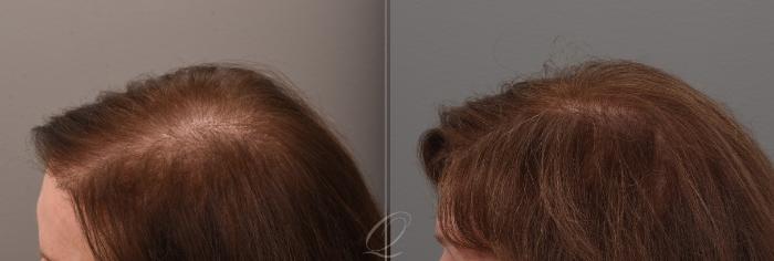 Before & After Female FUT Hair Transplant Case 1001889 Left Oblique View in Rochester, Buffalo, & Syracuse, NY