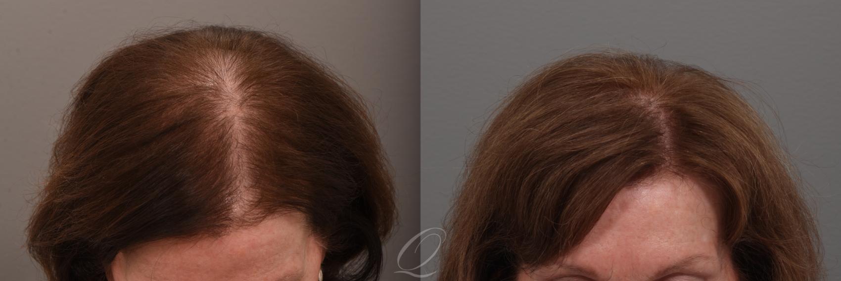 Female FUT Hair Transplant Case 1001889 Before & After Left Side | Serving Rochester, Syracuse & Buffalo, NY | Quatela Center for Plastic Surgery