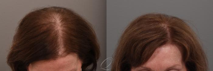 Before & After Female FUT Hair Transplant Case 1001889 Left Side View in Rochester, Buffalo, & Syracuse, NY