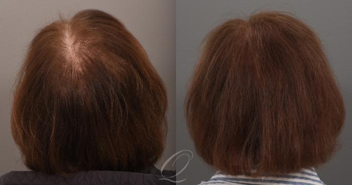 Before & After Female FUT Hair Transplant Case 1001889 Right Oblique View in Rochester, Buffalo, & Syracuse, NY