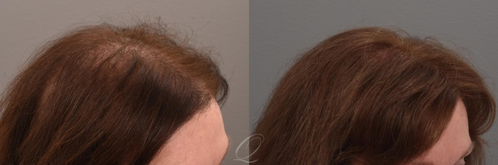 Female FUT Hair Transplant Case 1001889 Before & After Right Side | Serving Rochester, Syracuse & Buffalo, NY | Quatela Center for Plastic Surgery