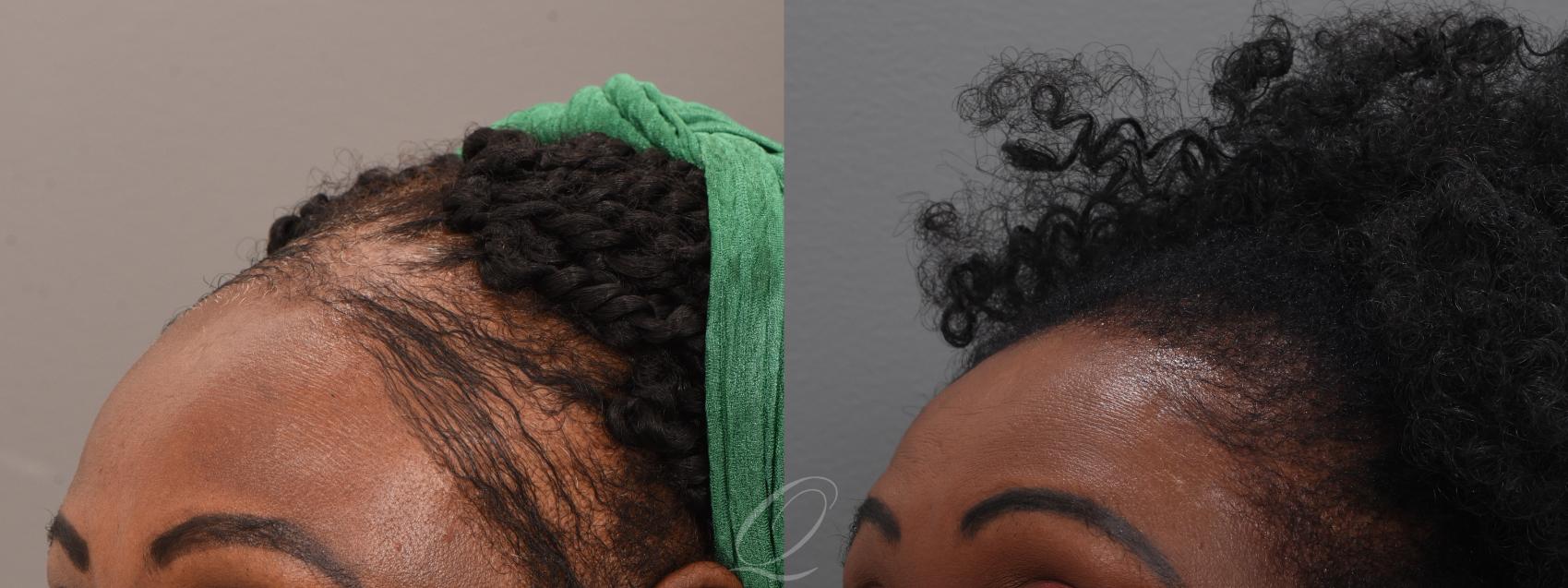 PRP Injections Case 1001914 Before & After Left Oblique | Serving Rochester, Syracuse & Buffalo, NY | Quatela Center for Plastic Surgery