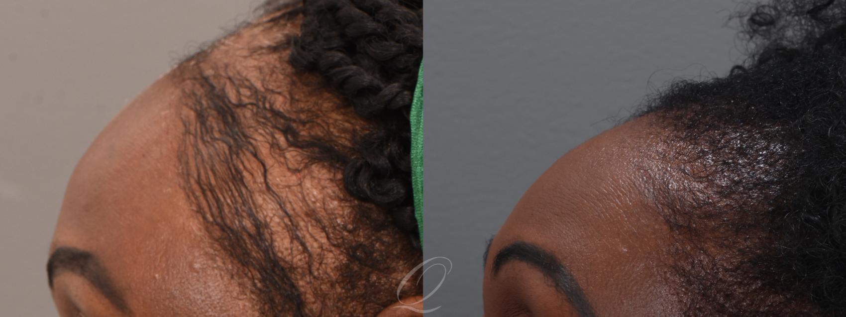 PRP Injections Case 1001914 Before & After Left Side | Serving Rochester, Syracuse & Buffalo, NY | Quatela Center for Plastic Surgery