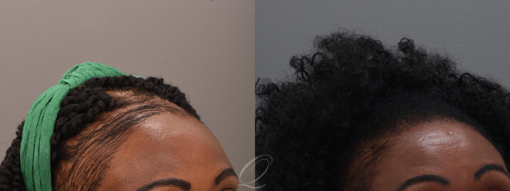 PRP Injections Case 1001914 Before & After Right Oblique | Serving Rochester, Syracuse & Buffalo, NY | Quatela Center for Plastic Surgery