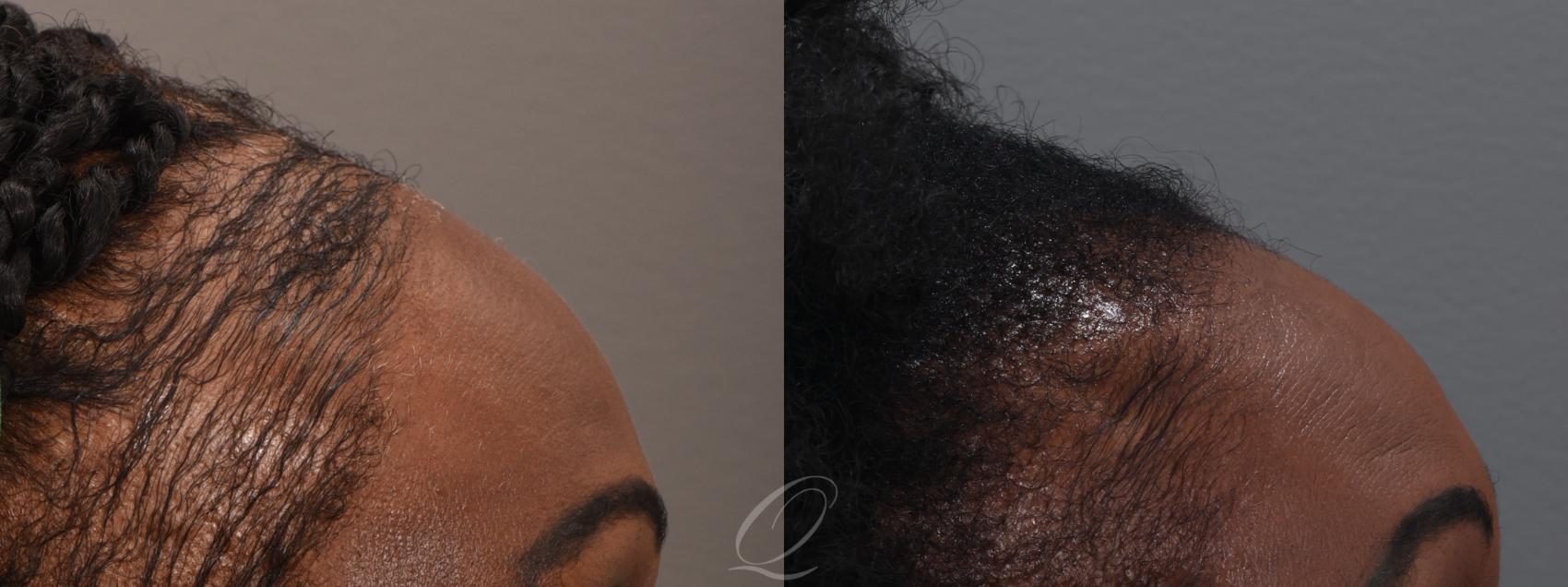 PRP Injections Case 1001914 Before & After Right Side | Serving Rochester, Syracuse & Buffalo, NY | Quatela Center for Plastic Surgery