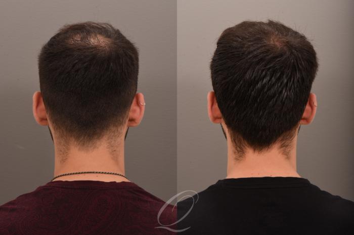 Before & After Non-Surgical Results Case 1001771 Back 2 View in Rochester, Buffalo, & Syracuse, NY