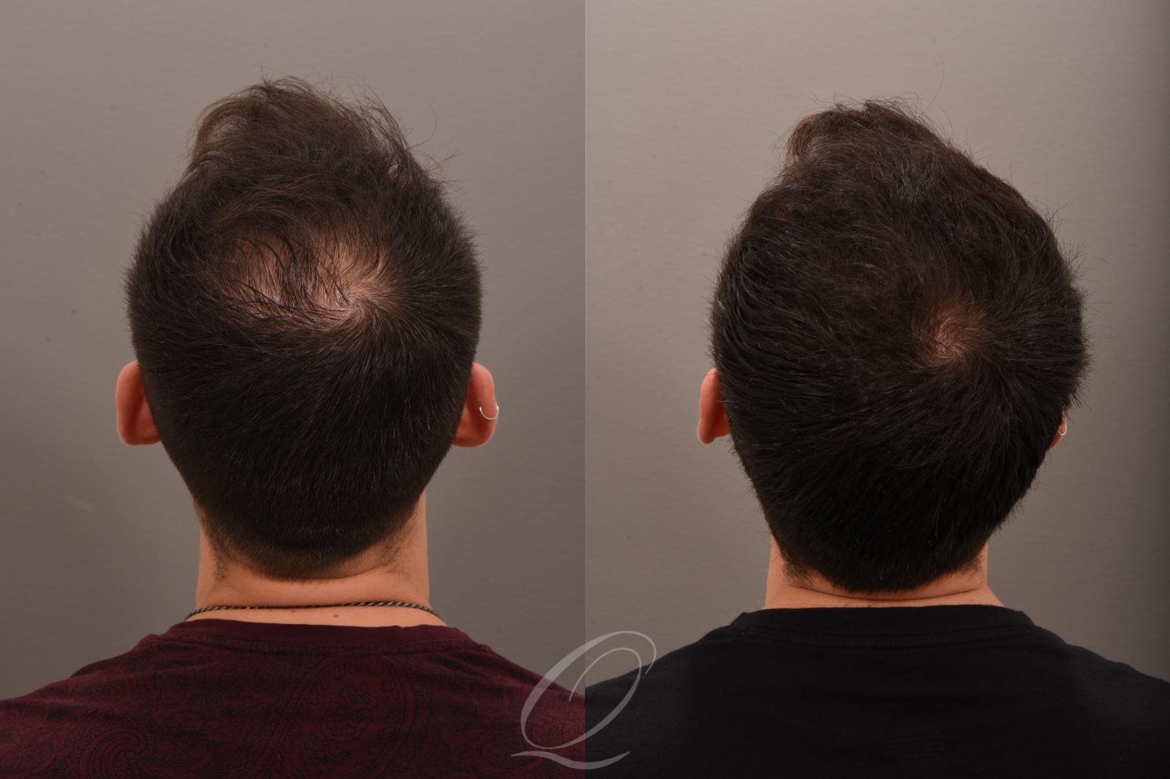 Finasteride, Minoxidil, and 82F/M Case 1001771 Before & After Back | Serving Rochester, Syracuse & Buffalo, NY | Quatela Center for Plastic Surgery