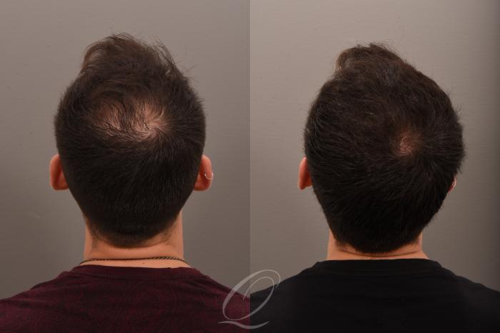 Before & After Finasteride, Minoxidil, and 82F/M Case 1001771 Back View in Rochester, Buffalo, & Syracuse, NY