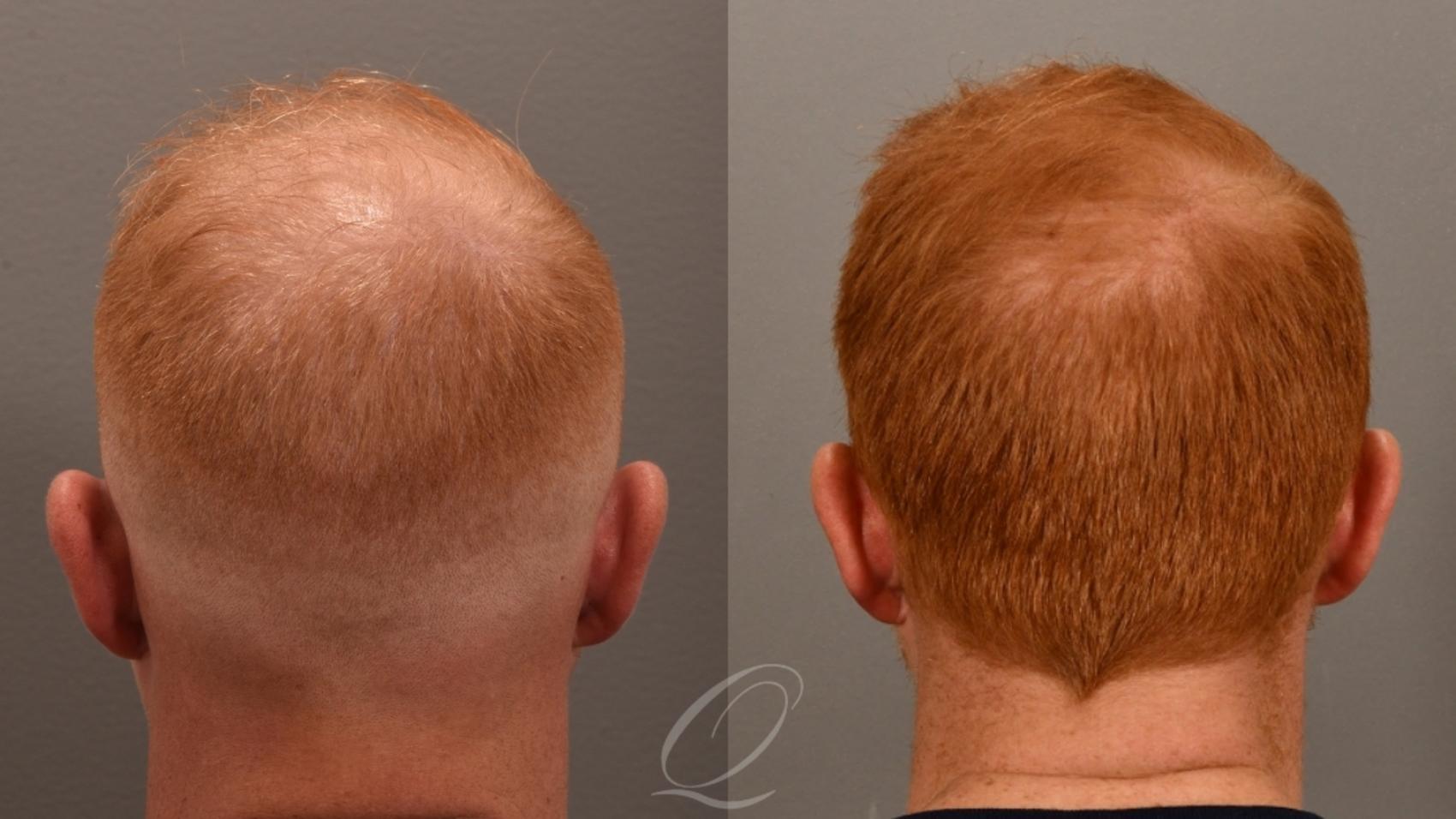 Non-Surgical Results Case 1001831 Before & After Back | Serving Rochester, Syracuse & Buffalo, NY | Quatela Center for Plastic Surgery