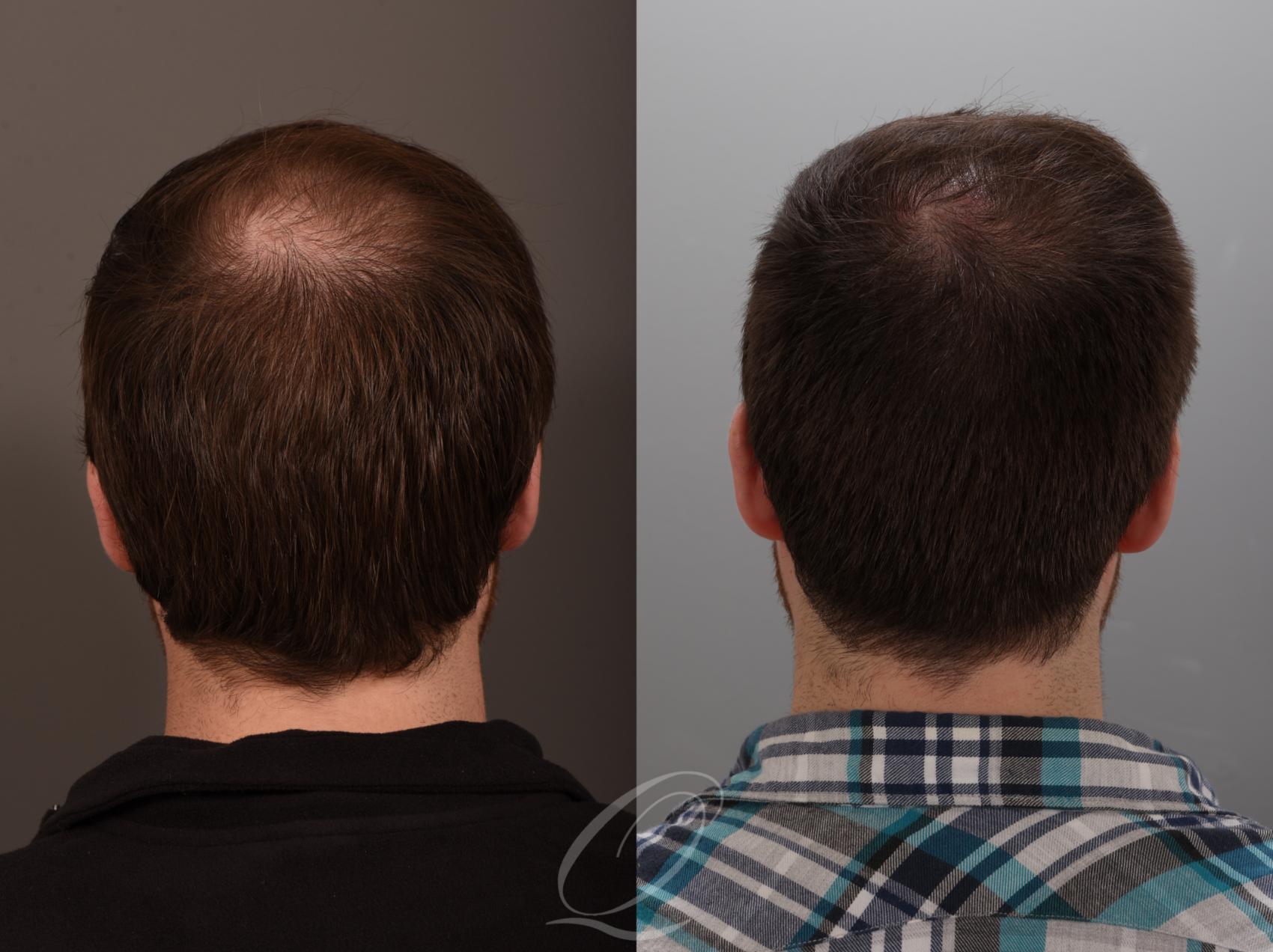 Finasteride, Minoxidil, and 82F/M Case 1001881 Before & After back 2  | Serving Rochester, Syracuse & Buffalo, NY | Quatela Center for Plastic Surgery