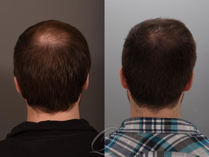 Finasteride, Minoxidil, and 82F/M Case 1001881 Before & After back 2  | Serving Rochester, Syracuse & Buffalo, NY | Quatela Center for Plastic Surgery