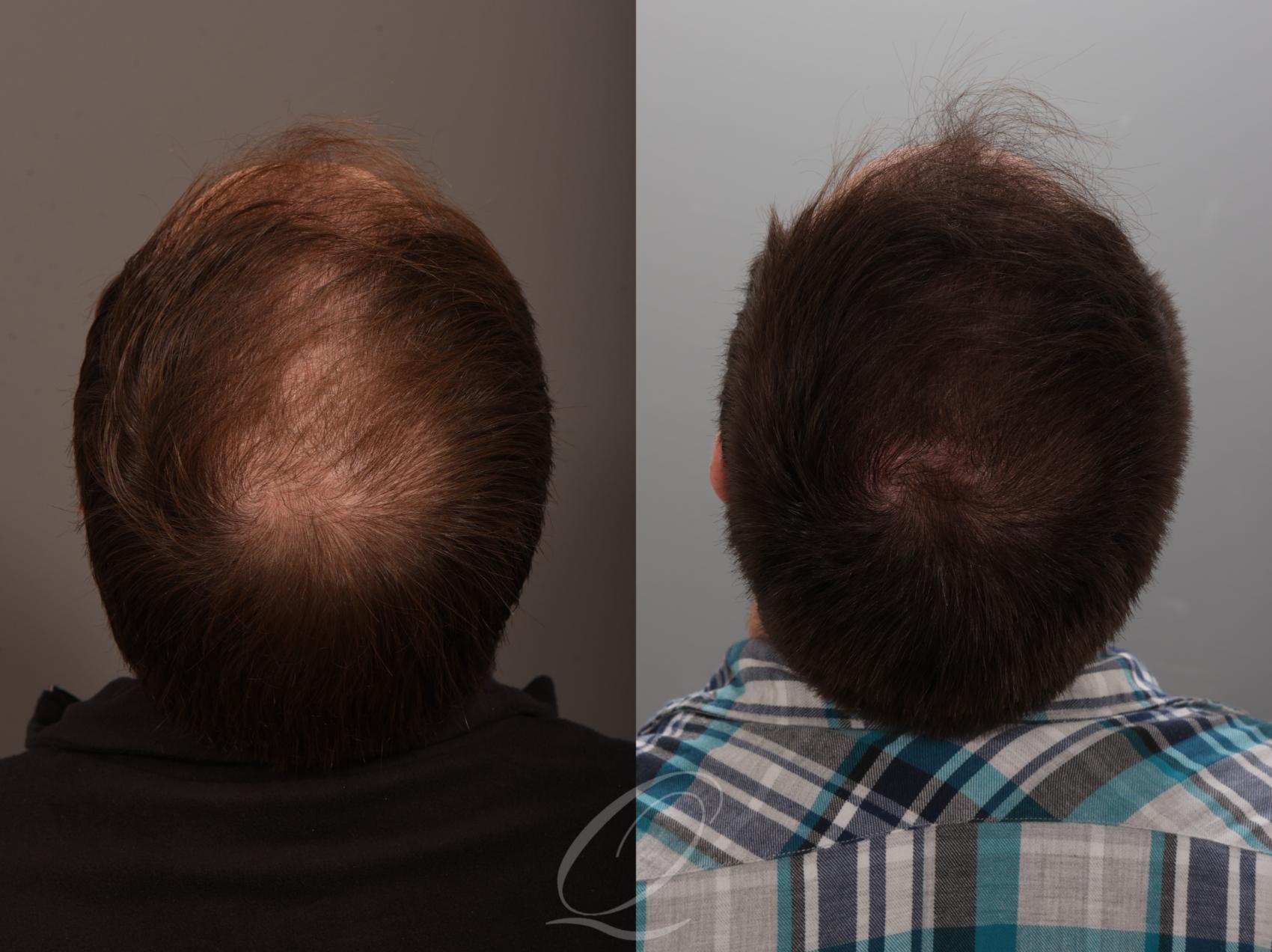 Finasteride, Minoxidil, and 82F/M Case 1001881 Before & After Back | Serving Rochester, Syracuse & Buffalo, NY | Quatela Center for Plastic Surgery