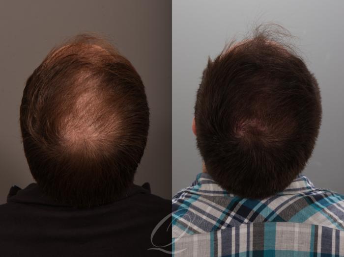 Finasteride, Minoxidil, and 82F/M Case 1001881 Before & After Back | Serving Rochester, Syracuse & Buffalo, NY | Quatela Center for Plastic Surgery