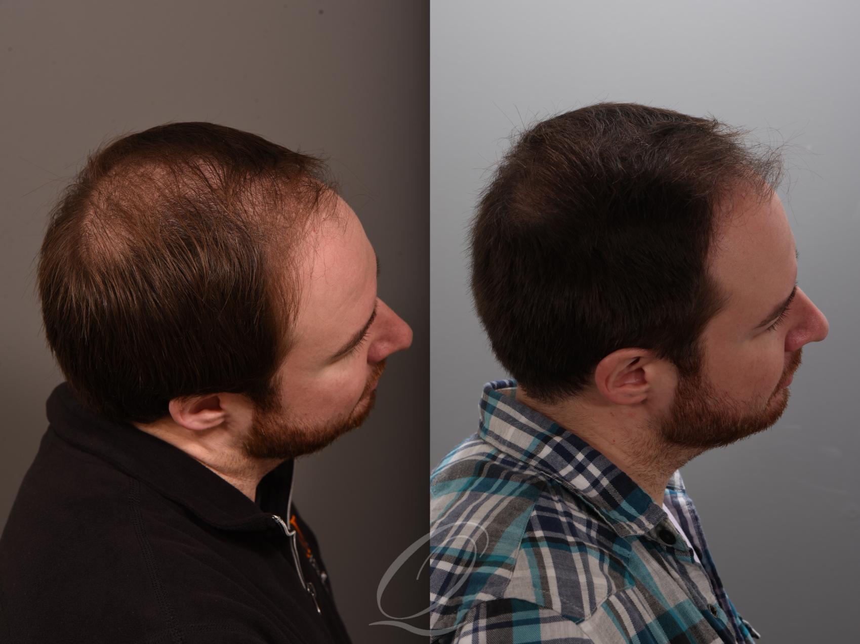 Finasteride, Minoxidil, and 82F/M Case 1001881 Before & After Left Side | Serving Rochester, Syracuse & Buffalo, NY | Quatela Center for Plastic Surgery