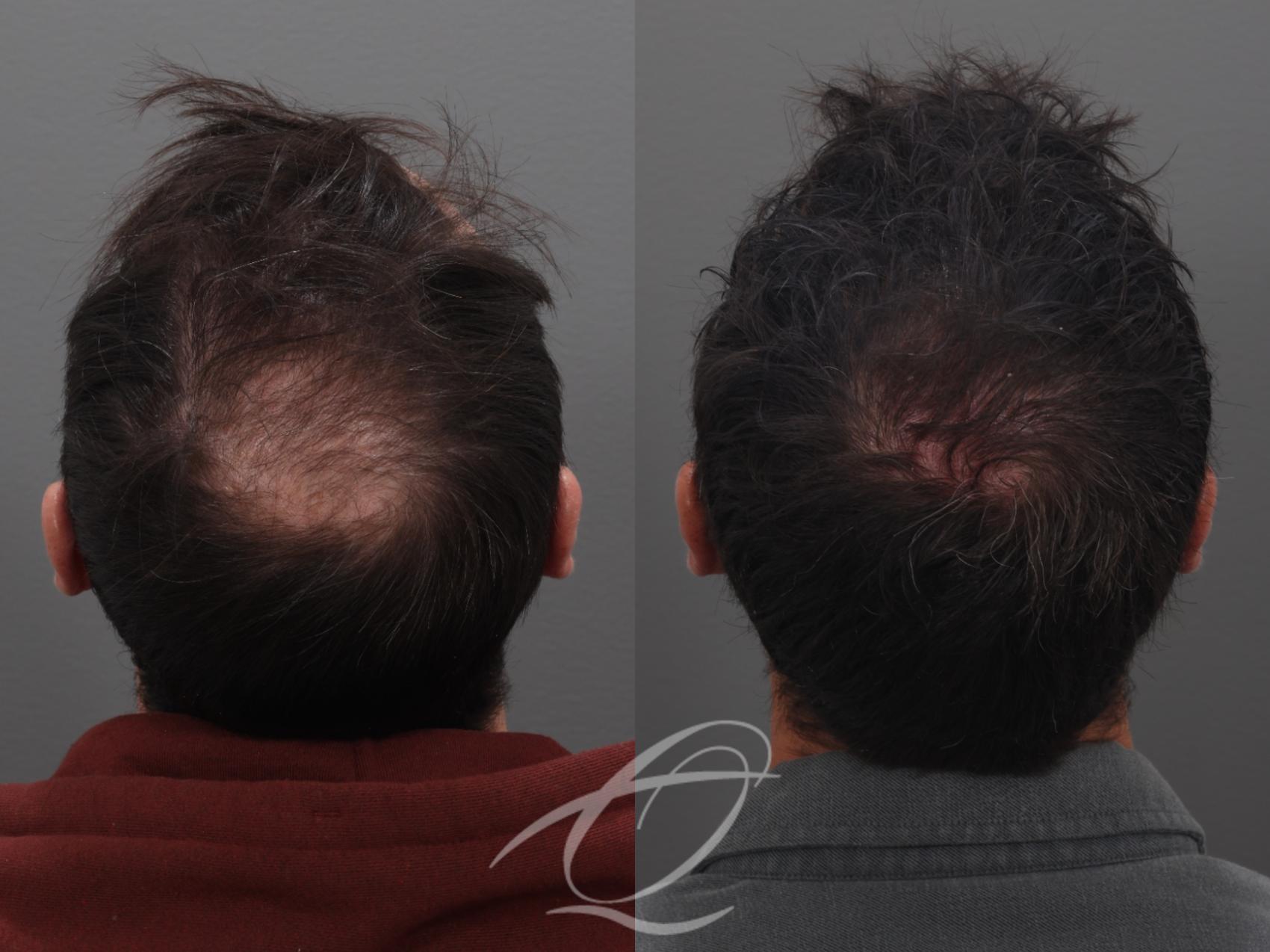 Finasteride, Minoxidil, and 82F/M Case 1002031 Before & After Back 2 | Serving Rochester, Syracuse & Buffalo, NY | Quatela Center for Plastic Surgery