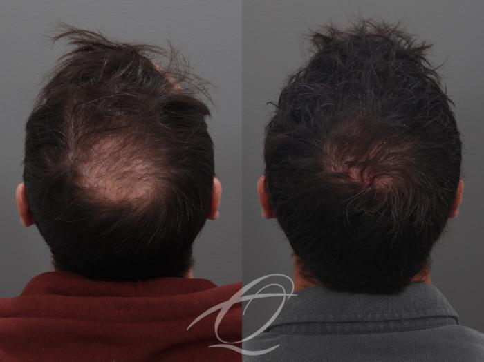 Finasteride, Minoxidil, and 82F/M Case 1002031 Before & After Back 2 | Serving Rochester, Syracuse & Buffalo, NY | Quatela Center for Plastic Surgery