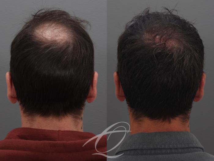 Finasteride, Minoxidil, and 82F/M Case 1002031 Before & After Back | Serving Rochester, Syracuse & Buffalo, NY | Quatela Center for Plastic Surgery
