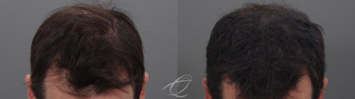 Finasteride, Minoxidil, and 82F/M Case 1002031 Before & After Front 2 | Serving Rochester, Syracuse & Buffalo, NY | Quatela Center for Plastic Surgery