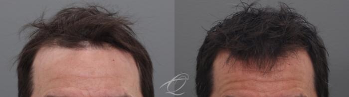 Finasteride, Minoxidil, and 82F/M Case 1002031 Before & After Front | Serving Rochester, Syracuse & Buffalo, NY | Quatela Center for Plastic Surgery