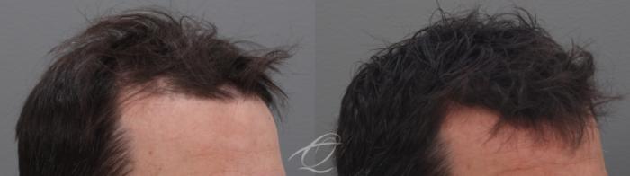 Finasteride, Minoxidil, and 82F/M Case 1002031 Before & After Right Oblique | Serving Rochester, Syracuse & Buffalo, NY | Quatela Center for Plastic Surgery