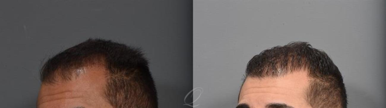 FUE Case 1001315 Before & After Left Oblique | Rochester, NY | Quatela Center for Hair Restoration
