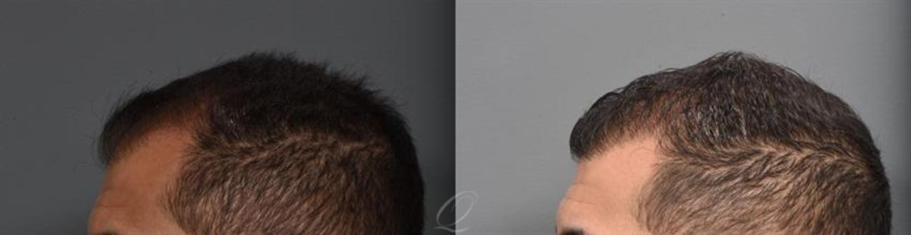 FUE Case 1001315 Before & After Left Side | Rochester, NY | Quatela Center for Hair Restoration