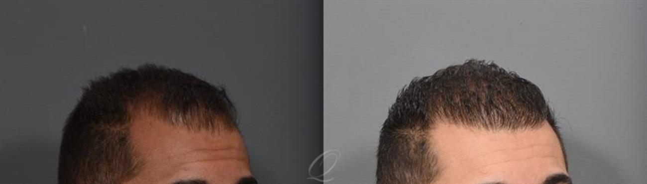 FUE Case 389 Before & After Right Oblique | Rochester, Buffalo, & Syracuse, NY | Quatela Center for Hair Restoration
