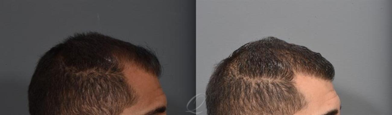 FUE Case 389 Before & After Right Side | Rochester, Buffalo, & Syracuse, NY | Quatela Center for Hair Restoration