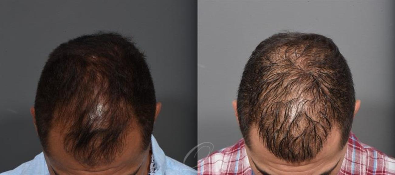 FUE Case 1001315 Before & After Top Front | Rochester, NY | Quatela Center for Hair Restoration