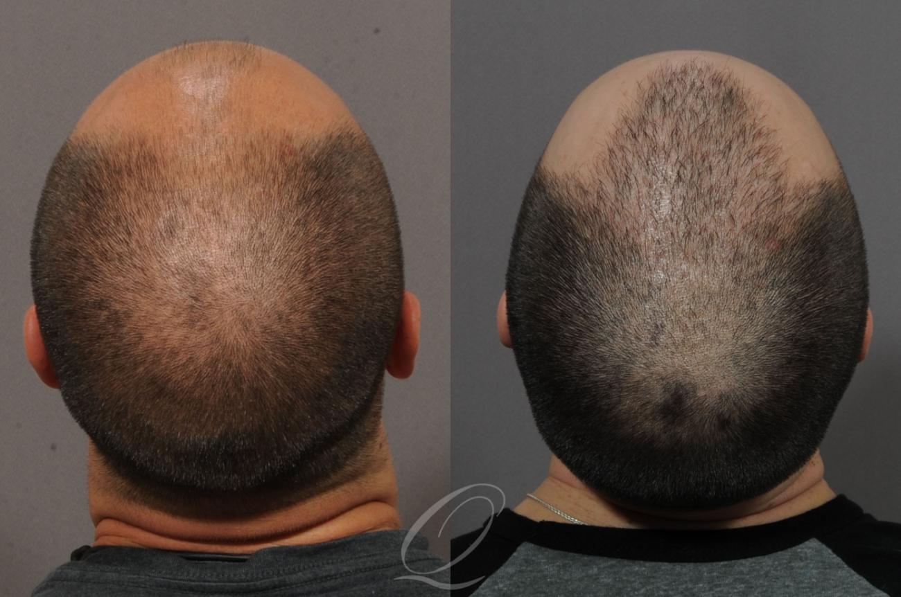 FUE Case 1055 Before & After View #2 | Rochester, NY | Quatela Center for Hair Restoration