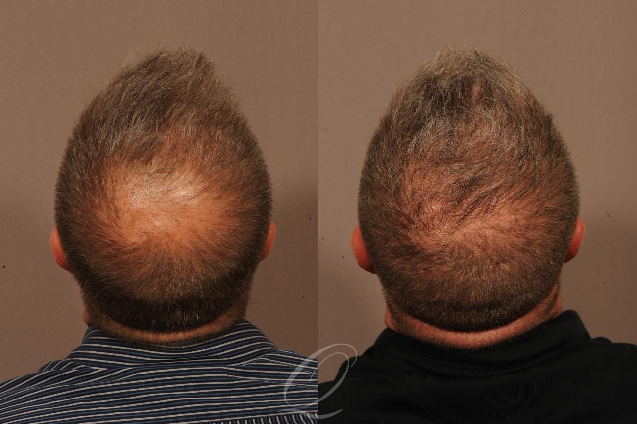 FUE Case 1334 Before & After View #2 | Rochester, NY | Quatela Center for Hair Restoration