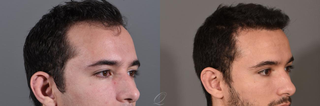FUT Case 1001295 Before & After View #3 | Rochester, NY | Quatela Center for Hair Restoration
